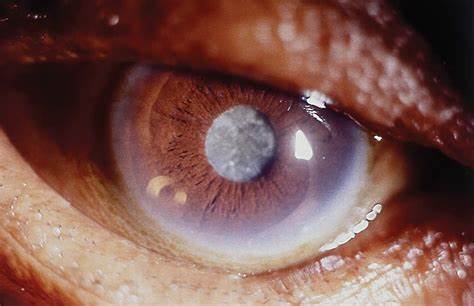 Moctar Dieng Badiane, médecin ophtalmologiste : « Entre 35 et 50 000 cas de cataracte sont recensés chaque année au Sénégal »